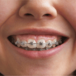 Common-Problems-with-Braces