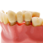 Dental-Bridge-Dallas