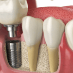 Dental-Implants-Crowley