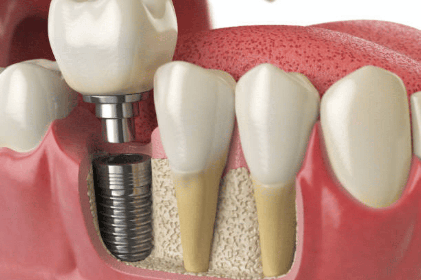 Things You Need To Maintain After Implant Procedure