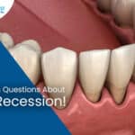 6 Common Questions About Gum Recession!