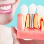 5 Signs That Your Dental Implant Needs To Be Replaced