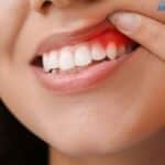 Gum-Disease-treatment