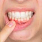 implants with periodontitis