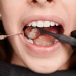 Dental sealants