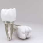 Dental Implants in Fort Worth, TX