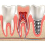 Dental implants in Houston TX