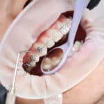 Braces in Grand Prairie TX
