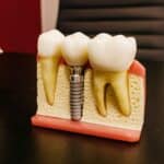 Dental implants in Crowley TX