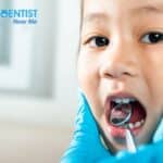 Cavities in Dallas, TX, Affordable Dentist Near Me of Dallas