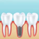 Dental implants Fort Worth TX