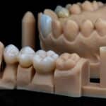 Dental Crown in Fort Worth, TX , Affordable Dentist Near Me of Fort Worth