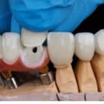 Dental Crowns in Grand Prairie, TX, Affordable Dentist Near Me - Grand Prairie