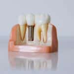 Dental Implants in Houston, TX , Affordable Dentist Near Me