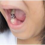 Dental Sealants in Longview, TX, Affordable Dentist Near Me of Longview