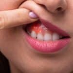 Gum Disease Treatment in Grand Prairie, TX, Affordable Dentist Near Me - Grand Prairie