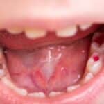 Infected Tooth Treatment in Longview, TX , Affordable Dentist Near Me of Longview