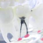 Root Canal Treatment in Fort Worth, TX, Affordable Dentist Near Me of Fort Worth
