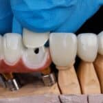 Veneers in Lancaster, TX , Affordable Dentist Near Me of Lancaster