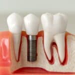 Dental Implants in Crowley, TX, Affordable Dentist Near Me - Crowley