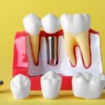 Dental Implants in Houston, TX, Affordable Dentist Near Me - Houston