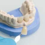 Dental Veneers in Lancaster, TX, Affordable Dentist Near Me of Lancaster