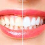 Teeth Whitening in Waco, TX, Affordable Dentist Near Me - Waco