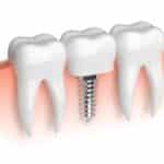 Dental Implants in Fort Worth, TX, Affordable Dentist Near Me of Fort Worth