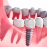 Dental Implants in Fort Worth, TX, Affordable Dentist Near Me of Fort Worth