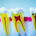 Root Canal Therapy in Waco, TX, Affordable Dentist Near Me - Waco
