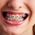 Dental Braces in Fort Worth, TX, Affordable Dentist Near Me of Fort Worth