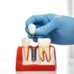 Dental Implants in Fort Worth, TX, Affordable Dentist Near Me of Fort Worth