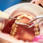 Tooth Extractions in Waco, TX, Affordable Dentist Near Me - Waco