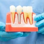 Dental Implant in Grand Prairie, TX, Affordable Dentist Near Me - Grand Prairie
