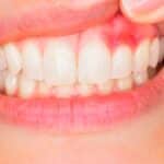 Periodontal Gum Disease Treatment in Grand Prairie, TX, Affordable Dentist Near Me - Grand Prairie