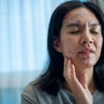dental crown cement and allergic reactions