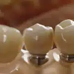 a close-up photo of a bright smile with perfectly aligned dental implants in tyler, texas.