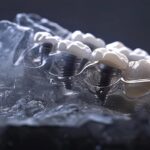 a close-up of a dental implant integrated seamlessly with the jawbone, preventing further bone loss.