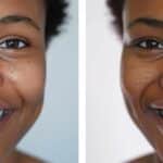 a patient smiling confidently with a same-day dental implant shining brightly in their mouth.