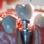 a skilled dentist carefully placing a gleaming dental implant into a patient's jaw.