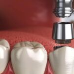 a skilled dentist carefully placing a gleaming titanium dental implant into a patient's jaw in fort worth.