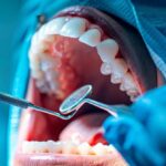 an open mouth with a look of discomfort as a dentist extracts a tooth using forceps.