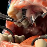 a patient's open mouth with a dentist carefully extracting a tooth using precision tools.