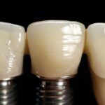 a close-up of a patient in a modern dental clinic, showcasing a radiant smile transformed by a dental implant, with bright, clinical lighting highlighting the glimmer of the implant against a backdrop of sleek, professional dental tools.