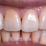 a close-up of a confident smiling individual showcasing radiant teeth, highlighting the natural elegance and advantages of dental implants over traditional dentures, illuminated by soft, warm lighting to enhance the overall allure.