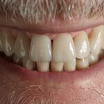 a radiant close-up of a person smiling broadly, showcasing a perfect set of dental implants that gleam under soft, warm lighting, emphasizing the transformative power of enhanced smiles.