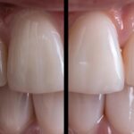 a radiant smile featuring flawless dental implants captured in soft natural light, highlighting the transformation and confidence they bring.