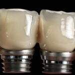 a radiant smile showcasing perfectly aligned dental implants glistens under soft, natural light, emphasizing their transformative role in enhancing oral health.