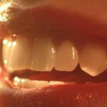 a striking close-up of an open mouth showcasing a flawless row of dental implants gleaming under soft, white light, contrasted against a blurred background featuring a traditional set of dentures, emphasizing the modernity and durability of implants.