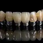 a radiant smile adorned with perfectly aligned dental implants gleams under soft, natural lighting, symbolizing the transformative power of advanced dental care and enhanced well-being.